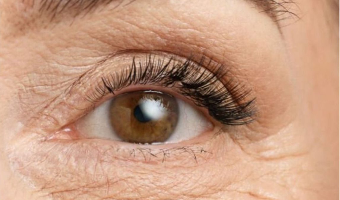 flacidez nos olhos e olheiras