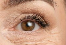 flacidez nos olhos e olheiras