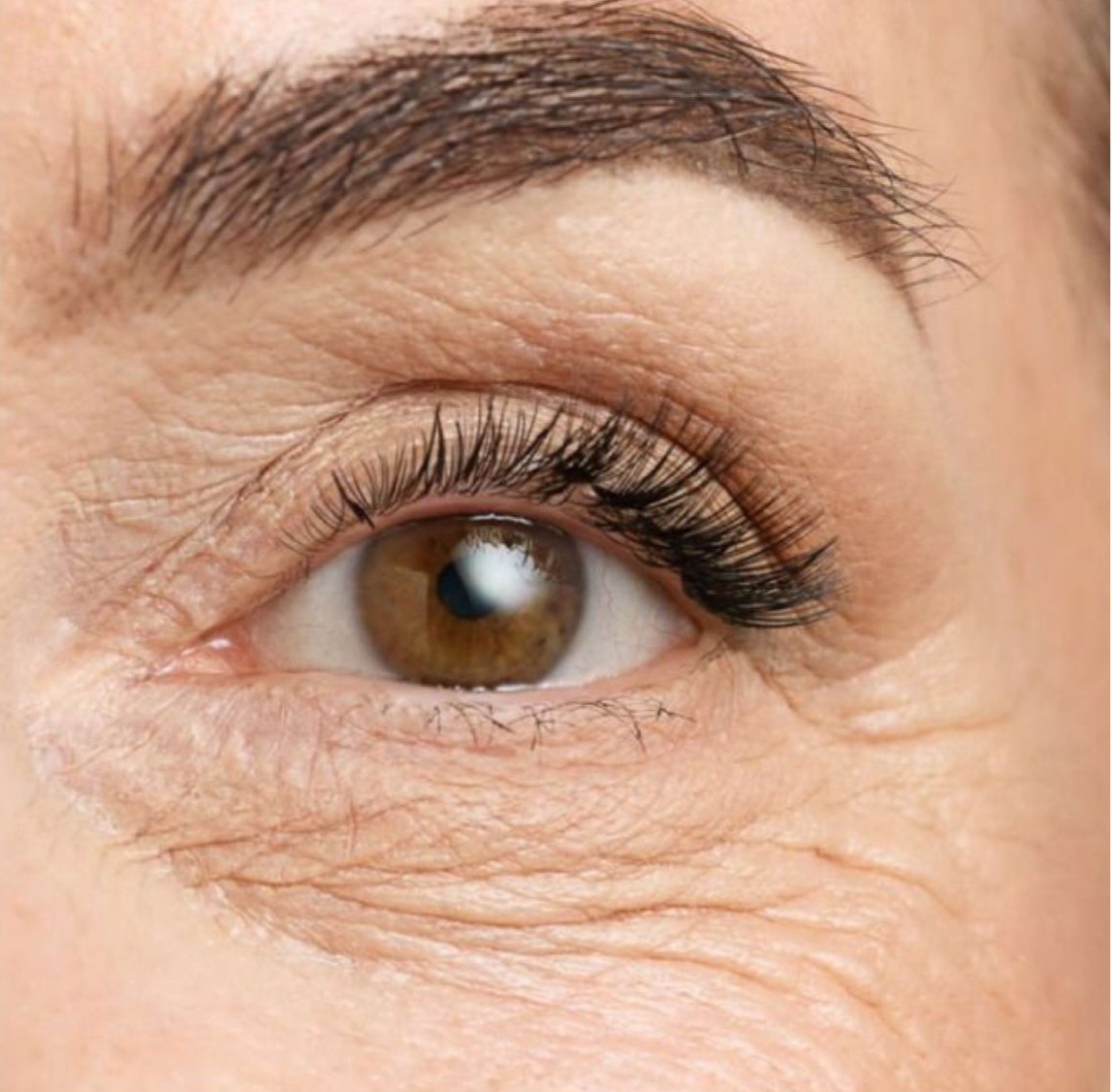 flacidez nos olhos e olheiras
